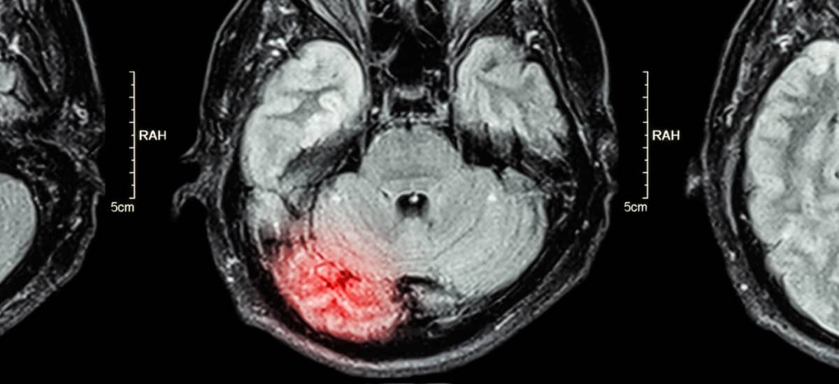Brain Injury Attorney in Los Angeles
